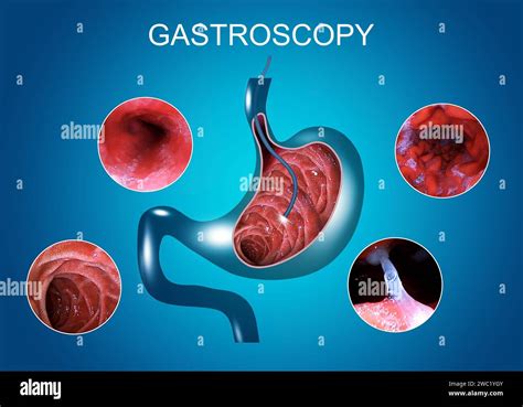 gastroscopy brentford